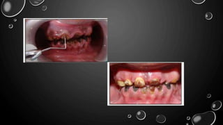 The flap techniques for pocket therapy | PPTX