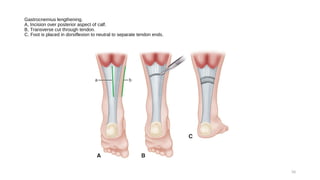 Modified Racquet Incision Foot The foot in cp part 1 of 3 | PPT