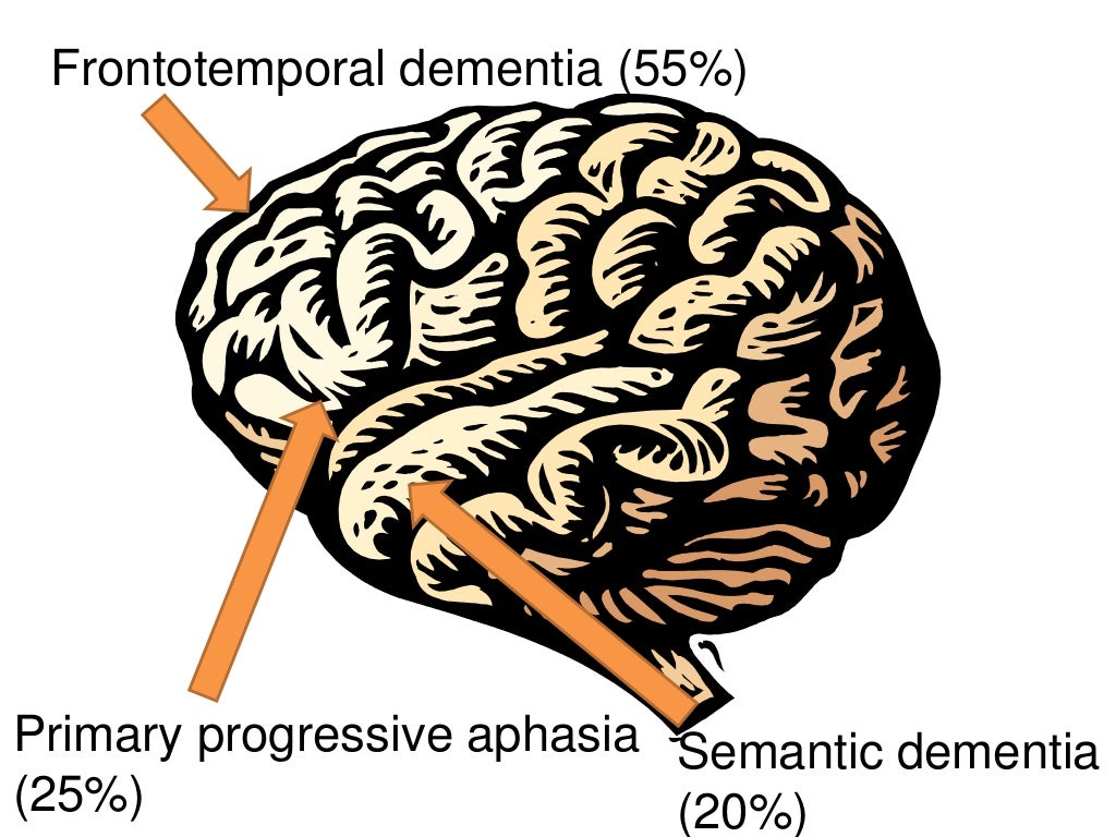 The Frontotemporal Dementias