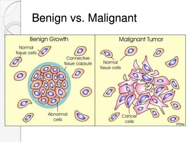 Benign and malignant tumours pdf