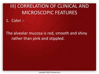 III) CORRELATION OF CLINICAL AND
MICROSCOPIC FEATURES
1. Color :-
The alveolar mucosa is red, smooth and shiny
rather than pink and stippled.
Copyright ©2021 Periowiki.com
 