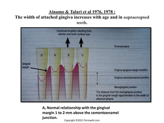 Ainamo & Talari et al 1976, 1978 :
The width of attached gingiva increases with age and in supraerupted
teeth.
A, Normal relationship with the gingival
margin 1 to 2 mm above the cementoenamel
junction.
Copyright ©2021 Periowiki.com
 
