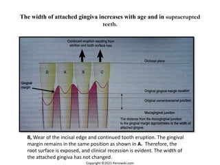 The width of attached gingiva increases with age and in supraerupted
teeth.
B, Wear of the incisal edge and continued tooth eruption. The gingival
margin remains in the same position as shown in A. Therefore, the
root surface is exposed, and clinical recession is evident. The width of
the attached gingiva has not changed.
Copyright ©2021 Periowiki.com
 