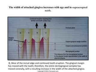 The width of attached gingiva increases with age and in supraerupted
teeth.
C, Wear of the incisal edge and continued tooth eruption. The gingival margin
has moved with the tooth; therefore, the entire dentogingival complex has
moved coronally, with a resulting increase in the width of the attached gingiva.
Copyright ©2021 Periowiki.com
 