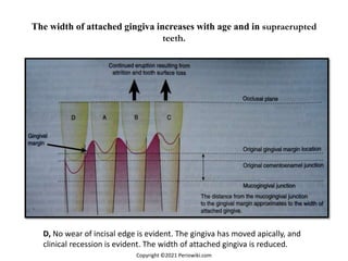 The width of attached gingiva increases with age and in supraerupted
teeth.
D, No wear of incisal edge is evident. The gingiva has moved apically, and
clinical recession is evident. The width of attached gingiva is reduced.
Copyright ©2021 Periowiki.com
 