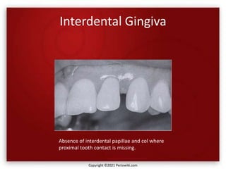 Interdental Gingiva
Absence of interdental papillae and col where
proximal tooth contact is missing.
Copyright ©2021 Periowiki.com
 