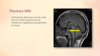 Pituitary MRI
• A pituitary adenoma can be seen
but it is often small and not
visible in a significant proportion
of cases.
 