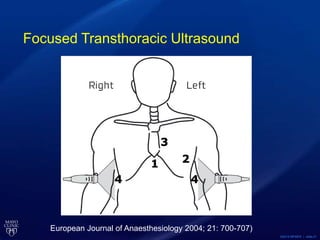©2015 MFMER | slide-21
Focused Transthoracic Ultrasound
European Journal of Anaesthesiology 2004; 21: 700-707)
 
