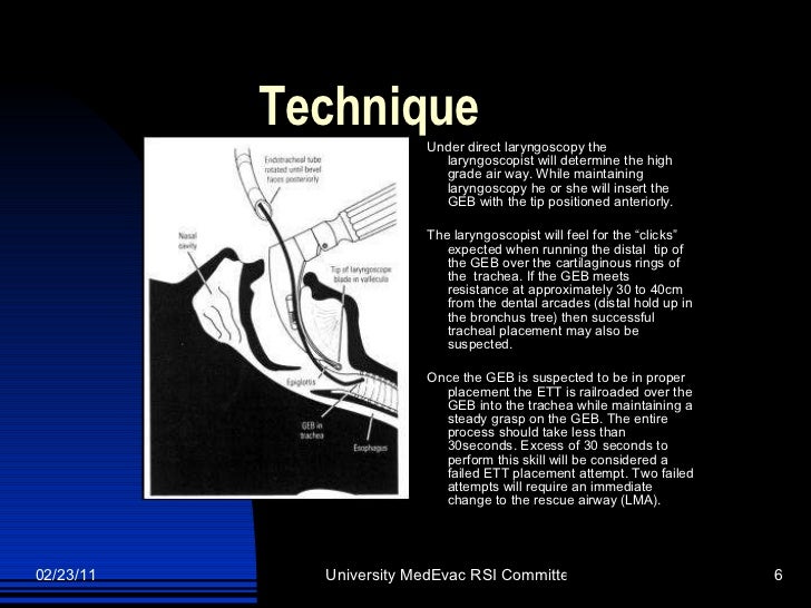The Gum Elastic Bougie As An Alternative Ett2