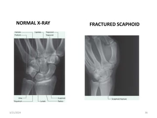 Normal Schapoid View Radiograph THE GROSS ANATOMY OF THE HAND PPPPTT.pptx