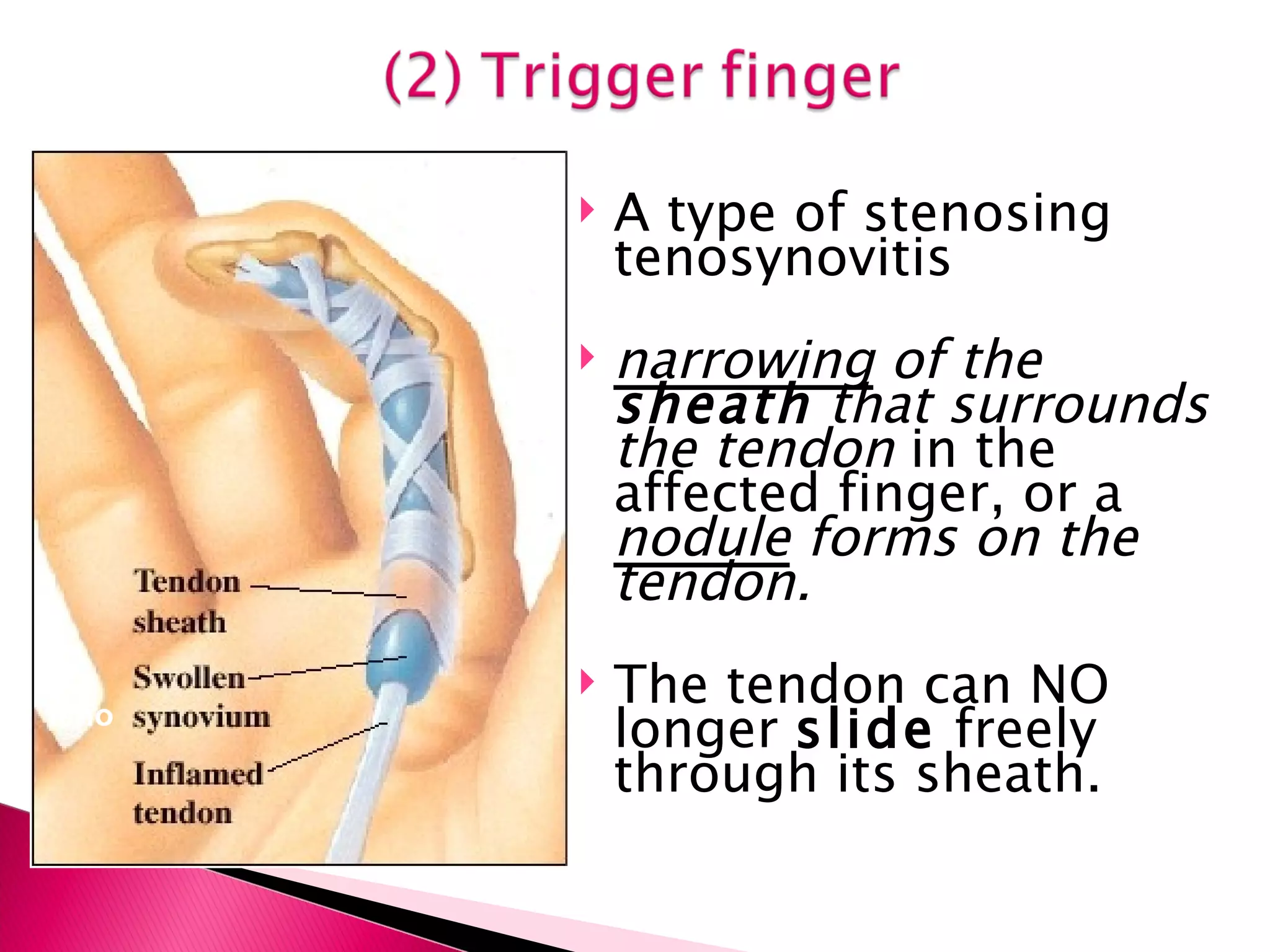 A type of stenosing tenosynovitis narrowing  of the  sheath  that surrounds the tendon  in the affected finger, or a  nodule  forms on the tendon. The tendon can NO longer  slide  freely through its sheath. teno 