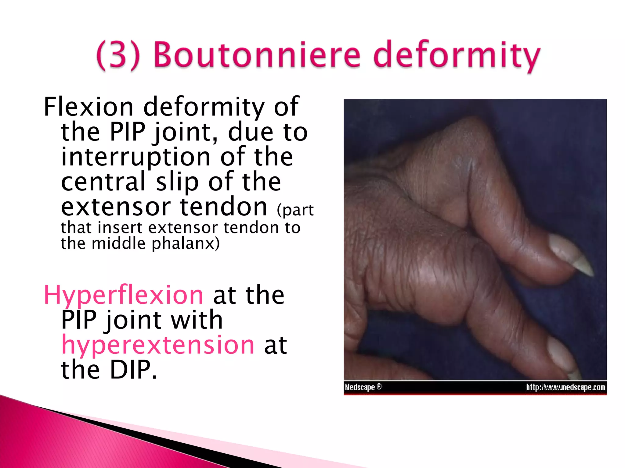 Flexion deformity of the PIP joint, due to interruption of the central slip of the extensor tendon  (part that insert extensor tendon to the middle phalanx)  Hyperflexion  at the PIP joint with  hyperextension  at the DIP. 