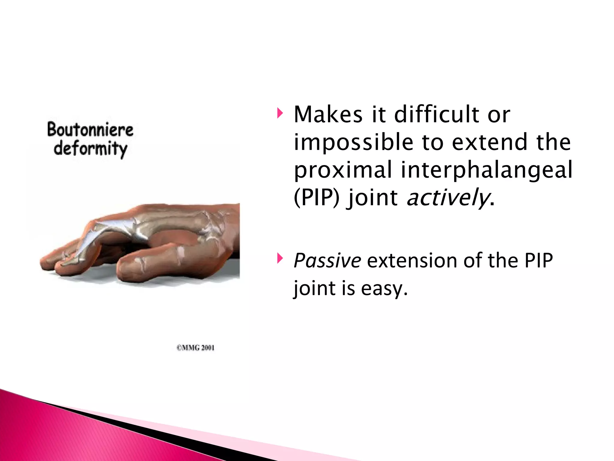 Makes it difficult or impossible to extend the proximal interphalangeal (PIP) joint  actively . Passive  extension of the PIP joint is easy.  