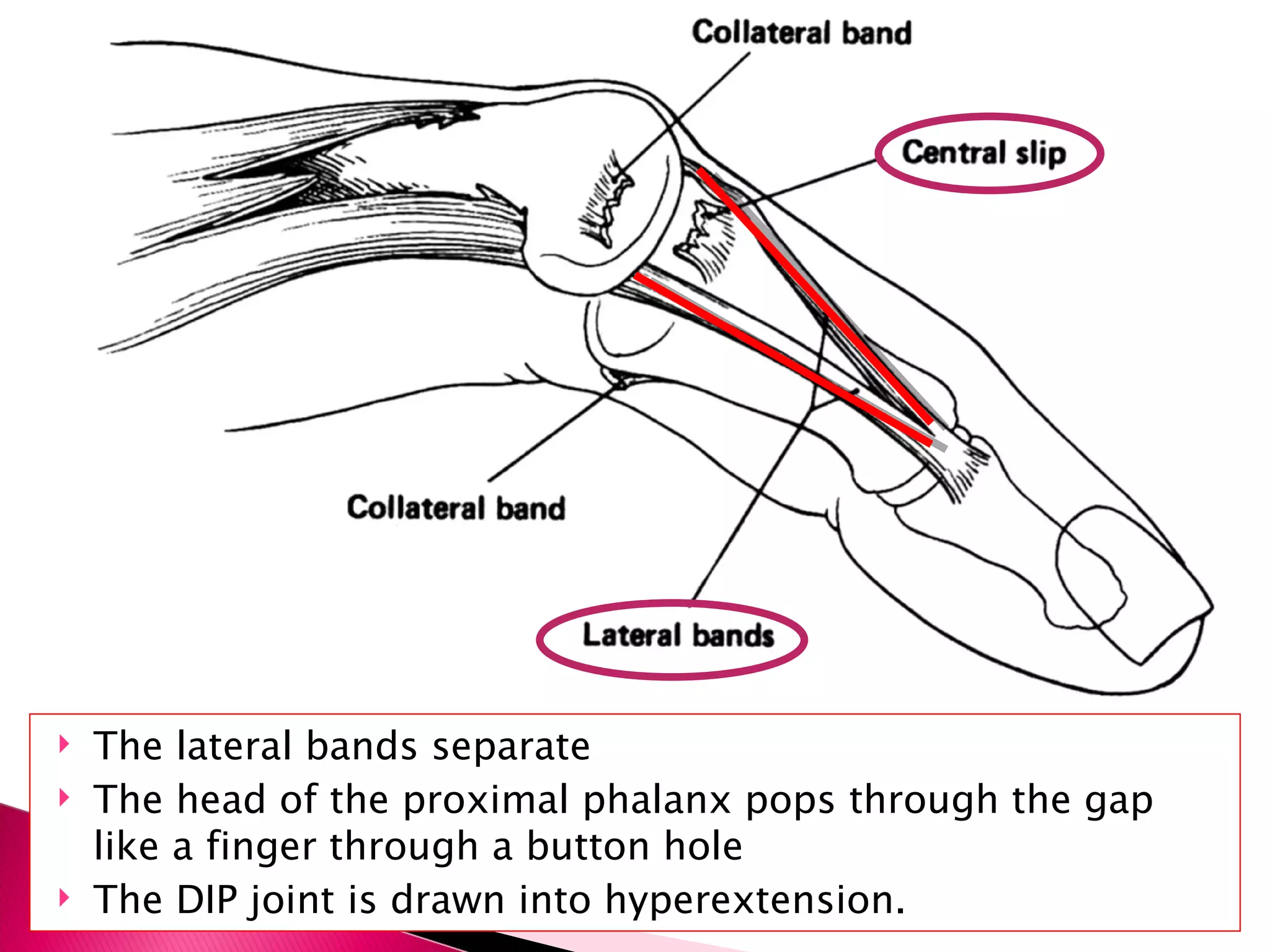 The lateral bands separate  The head of the proximal phalanx pops through the gap like a finger through a button hole  The DIP joint is drawn into hyperextension. 