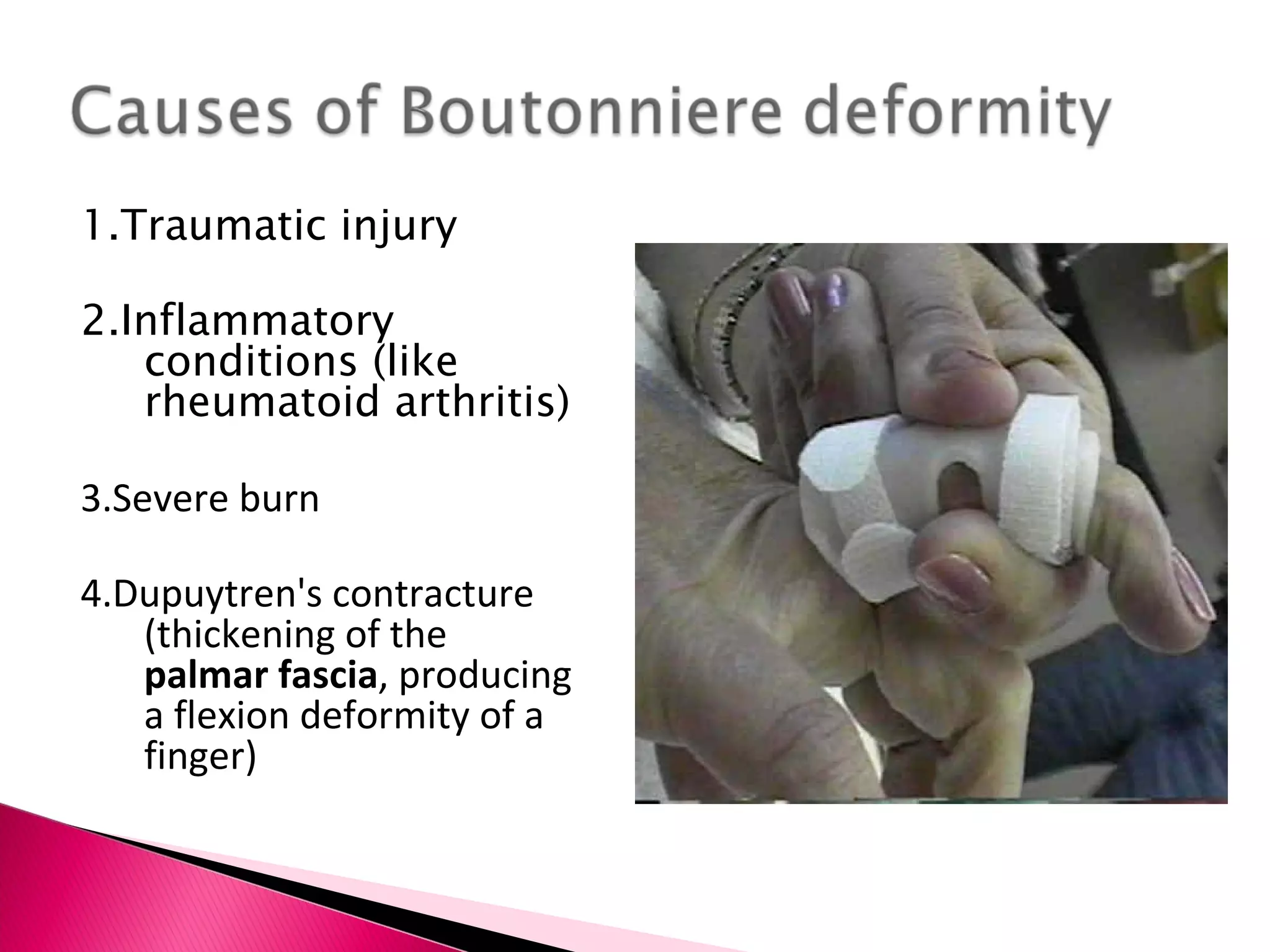 1.Traumatic injury 2.Inflammatory conditions (like rheumatoid arthritis) 3.Severe burn  4.Dupuytren's contracture (thickening of the  palmar fascia , producing a flexion deformity of a finger) 