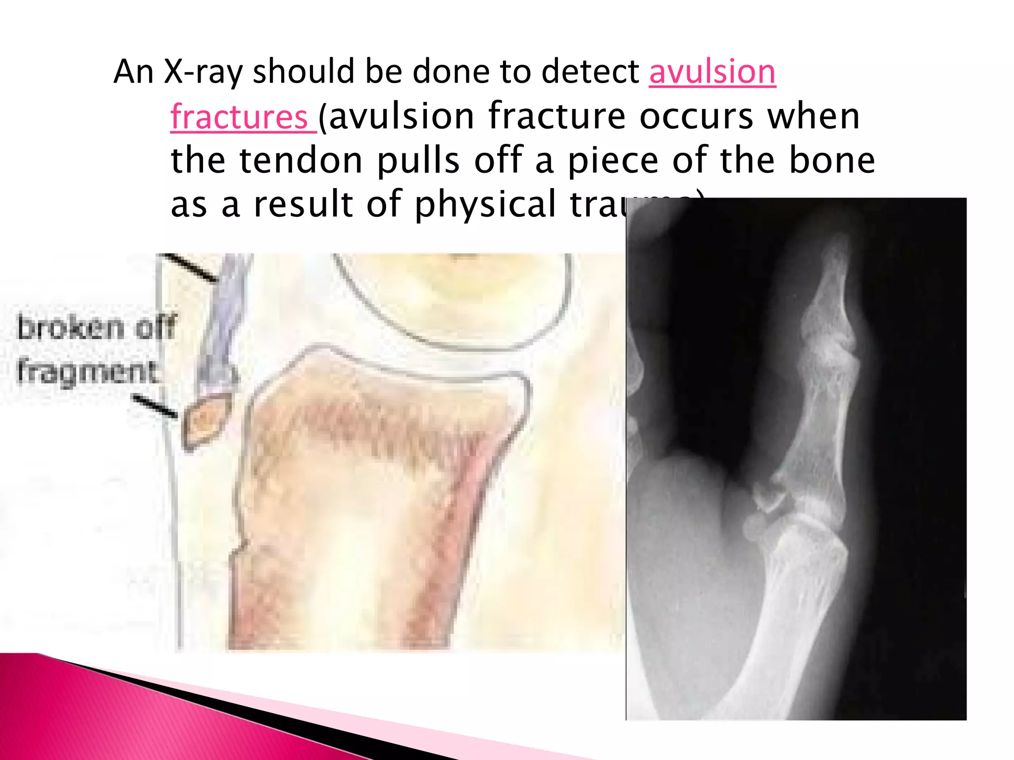 An X-ray should be done to detect  avulsion fractures  ( avulsion fracture occurs when the tendon pulls off a piece of the bone as a result of physical trauma) 