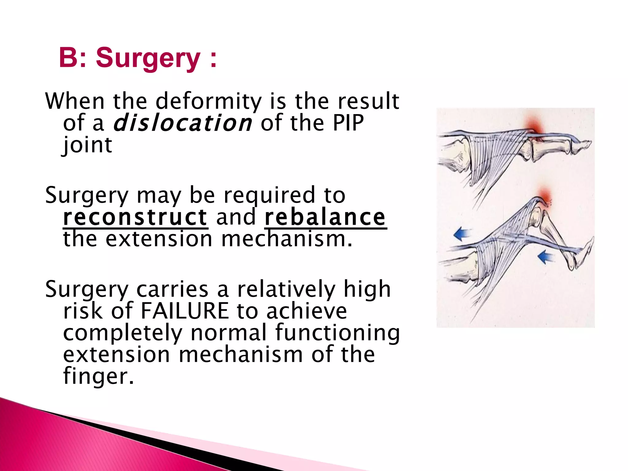 When the deformity is the result of a  dislocation  of the PIP joint  Surgery may be required to  reconstruct  and  rebalance  the extension mechanism. Surgery carries a relatively high risk of FAILURE to achieve completely normal functioning extension mechanism of the finger. B: Surgery : 