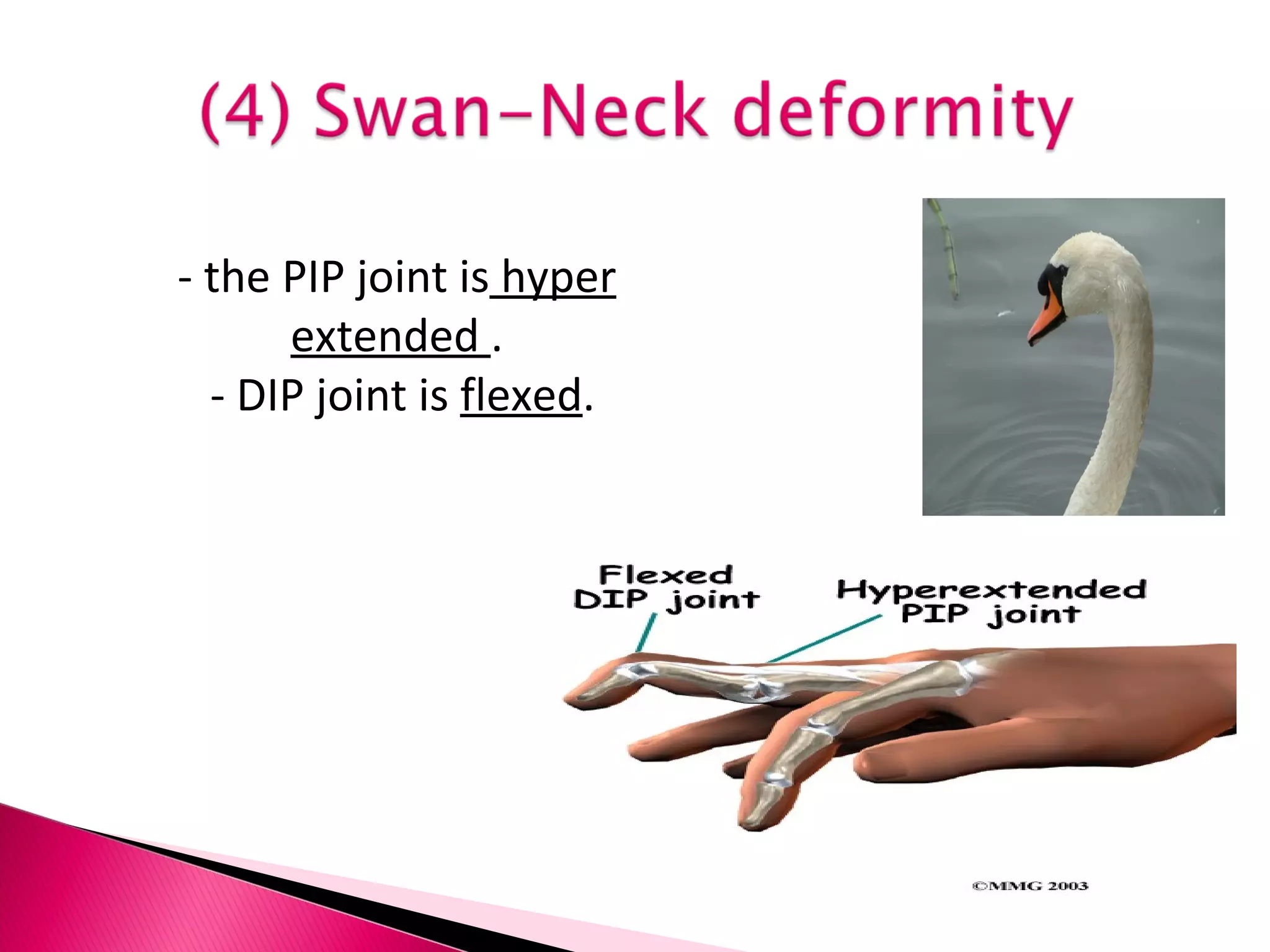 - the PIP joint is  hyper extended  . - DIP joint is  flexed .  