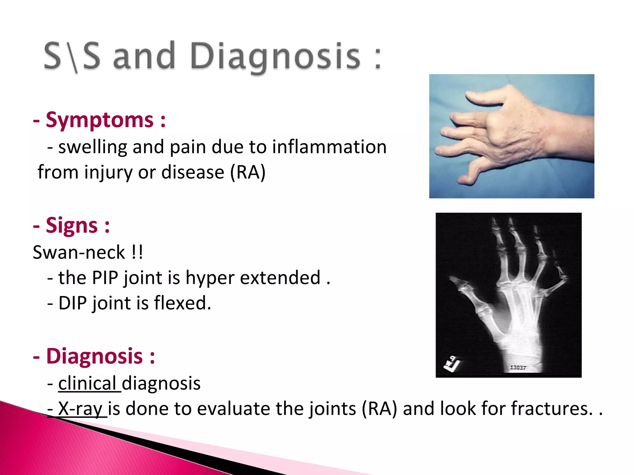 - Symptoms : - swelling and pain due to inflammation from injury or disease (RA) - Signs : Swan-neck !!  - the PIP joint is hyper extended . - DIP joint is flexed.  - Diagnosis : -  clinical  diagnosis  - X-ray  is done to evaluate the joints (RA) and look for fractures. .  