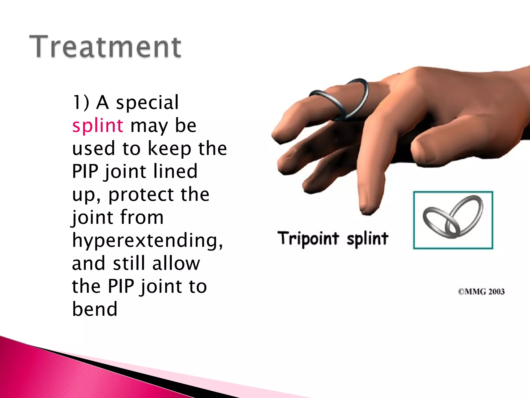 1) A special  splint  may be used to keep the PIP joint lined up, protect the joint from hyperextending, and still allow the PIP joint to bend 