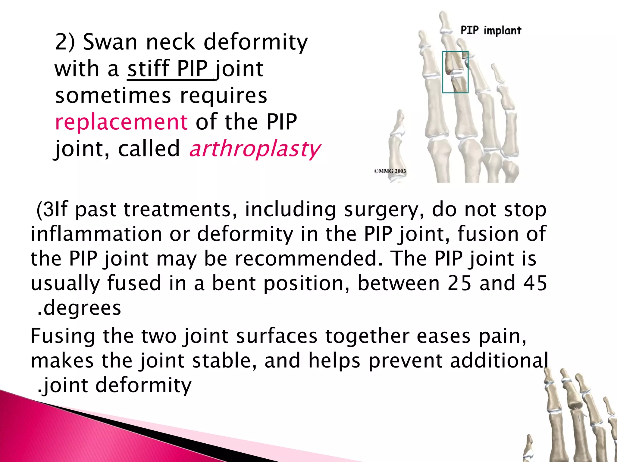 2) Swan neck deformity with a  stiff PIP  joint sometimes requires  replacement  of the PIP joint, called  arthroplasty 3)  If past treatments, including surgery, do not stop inflammation or deformity in the PIP joint, fusion of the PIP joint may be recommended. The PIP joint is usually fused in a bent position, between 25 and 45 degrees.  Fusing the two joint surfaces together eases pain, makes the joint stable, and helps prevent additional joint deformity.  