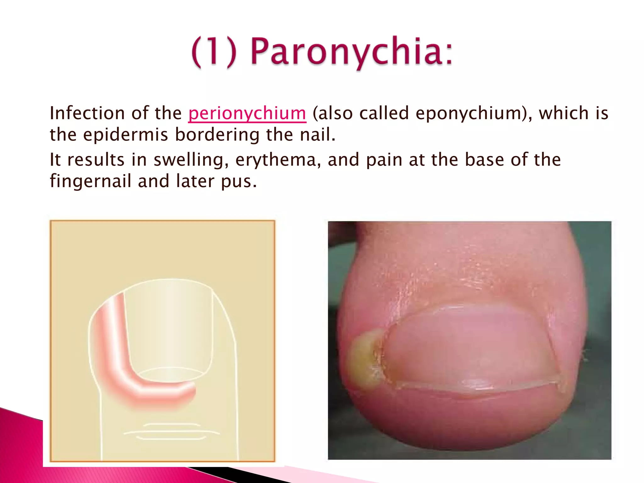 Infection of the  perionychium  (also called eponychium), which is the epidermis bordering the nail. It results in swelling, erythema, and pain at the base of the fingernail and later pus. 