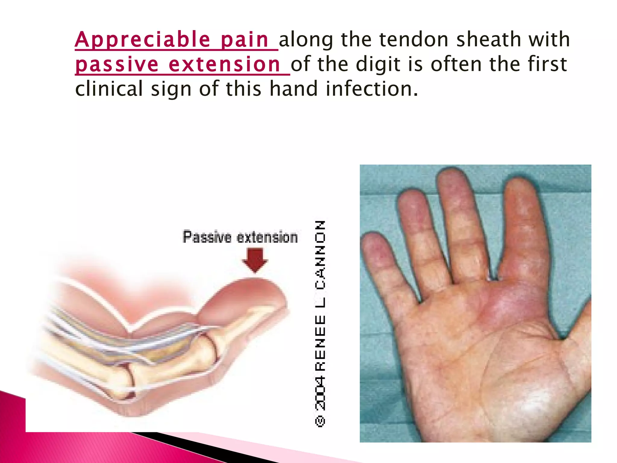 Appreciable pain  along the tendon sheath with  passive extension  of the digit is often the first clinical sign of this hand infection. 