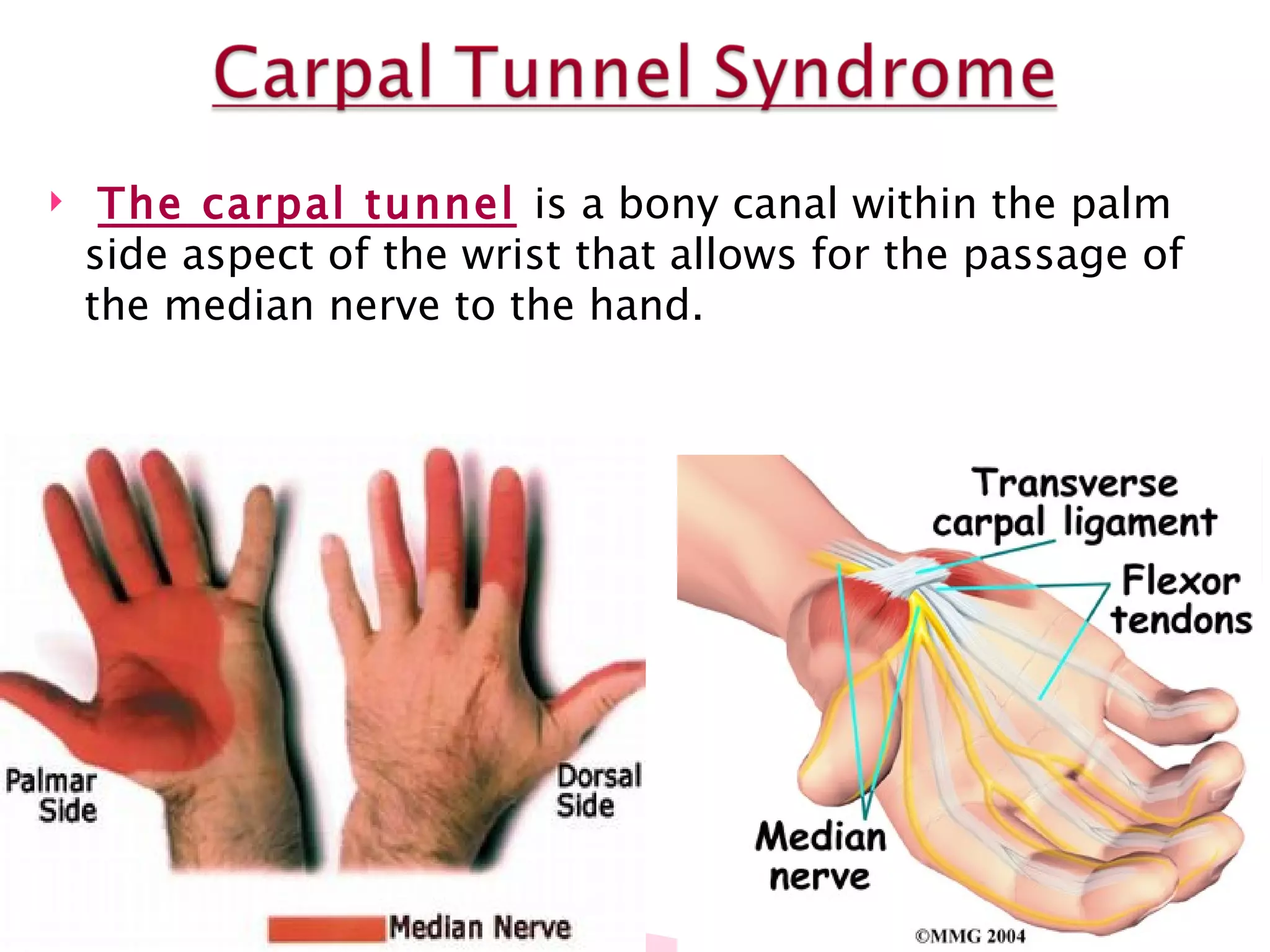 The carpal tunnel   is a bony canal within the palm side aspect of the wrist that allows for the passage of the median nerve to the hand.  