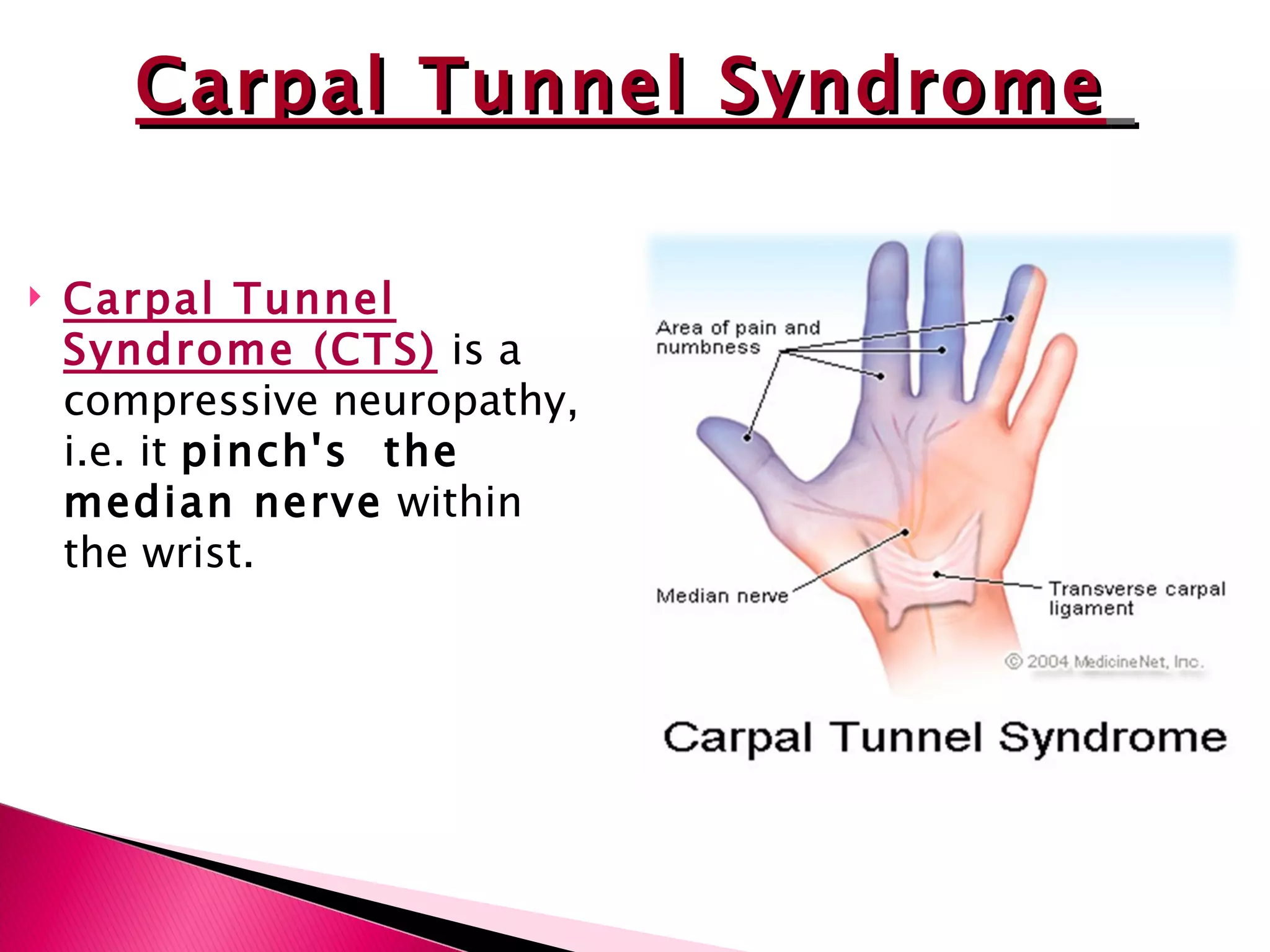 Carpal Tunnel Syndrome (CTS)  is a compressive neuropathy, i.e. it  pinch's  the median nerve  within the wrist. Carpal Tunnel Syndrome   