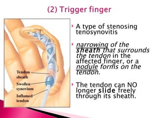 A type of stenosing tenosynovitis narrowing  of the  sheath  that surrounds the tendon  in the affected finger, or a  nodule  forms on the tendon. The tendon can NO longer  slide  freely through its sheath. teno 