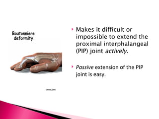 Makes it difficult or impossible to extend the proximal interphalangeal (PIP) joint  actively . Passive  extension of the PIP joint is easy.  