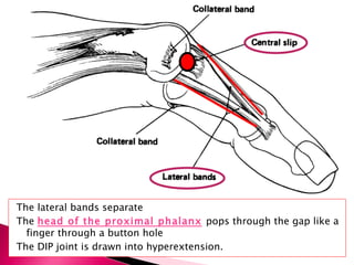The lateral bands separate  The  head of the proximal phalanx   pops through the gap like a finger through a button hole  The DIP joint is drawn into hyperextension. 