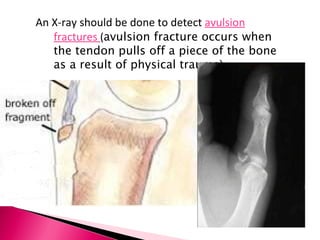 An X-ray should be done to detect  avulsion fractures  ( avulsion fracture occurs when the tendon pulls off a piece of the bone as a result of physical trauma) 