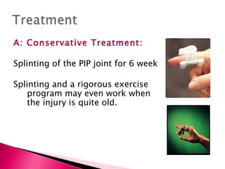 A: Conservative Treatment: Splinting of the PIP joint for 6 week Splinting and a rigorous exercise program may even work when the injury is quite old. 