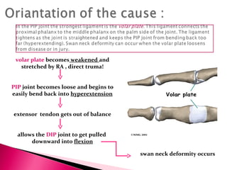 volar plate  becomes  weakened  and stretched by RA , direct truma! PIP  joint becomes loose and begins to easily bend back into  hyperextension extensor  tendon gets out of balance allows the  DIP  joint to get pulled  downward into  flexion swan neck deformity occurs 