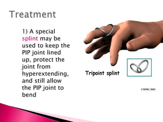 1) A special  splint  may be used to keep the PIP joint lined up, protect the joint from hyperextending, and still allow the PIP joint to bend 
