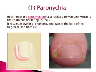 Infection of the  perionychium  (also called eponychium), which is the epidermis bordering the nail. It results in swelling, erythema, and pain at the base of the fingernail and later pus. 