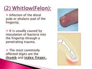 ♣   Infection of the distal pulp or phalanx pad of the fingertip. ♣   It is usually caused by inoculation of bacteria into the fingertip through a penetrating trauma.  ♣   The most commonly affected digits are the  thumb  and  index finger. 