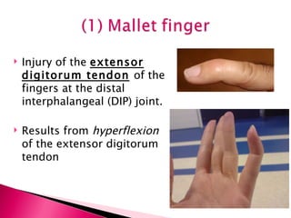 Injury of the  extensor digitorum tendon   of the fingers at the distal interphalangeal (DIP) joint. Results from  hyperflexion  of the extensor digitorum tendon 