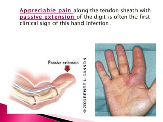 Appreciable pain  along the tendon sheath with  passive extension  of the digit is often the first clinical sign of this hand infection. 