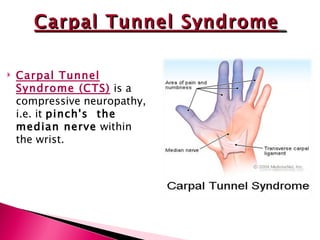 Carpal Tunnel Syndrome (CTS)  is a compressive neuropathy, i.e. it  pinch's  the median nerve  within the wrist. Carpal Tunnel Syndrome   