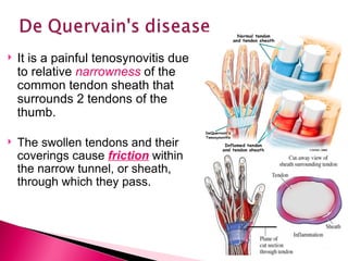It is a painful tenosynovitis due to relative  narrowness   of the common tendon sheath that surrounds 2 tendons of the thumb. The swollen tendons and their coverings cause  friction  within the narrow tunnel, or sheath, through which they pass. 