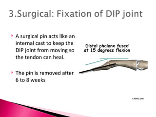 A surgical pin acts like an internal cast to keep the DIP joint from moving so the tendon can heal.  The pin is removed after 6 to 8 weeks 