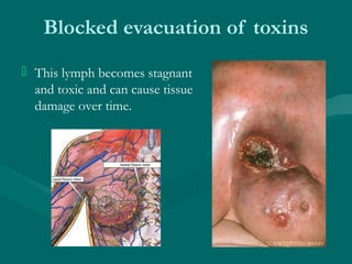 Blocked evacuation of toxins
 This lymph becomes stagnant
and toxic and can cause tissue
damage over time.
 