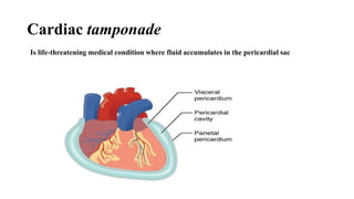 Cardiac tamponade
Is life-threatening medical condition where fluid accumulates in the pericardial sac
 