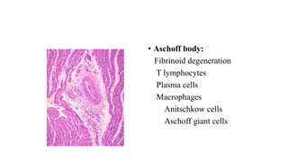 • Aschoff body:
Fibrinoid degeneration
T lymphocytes
Plasma cells
Macrophages
Anitschkow cells
Aschoff giant cells
 