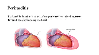 Pericarditis
Pericarditis is inflammation of the pericardium, the thin, two-
layered sac surrounding the heart
 
