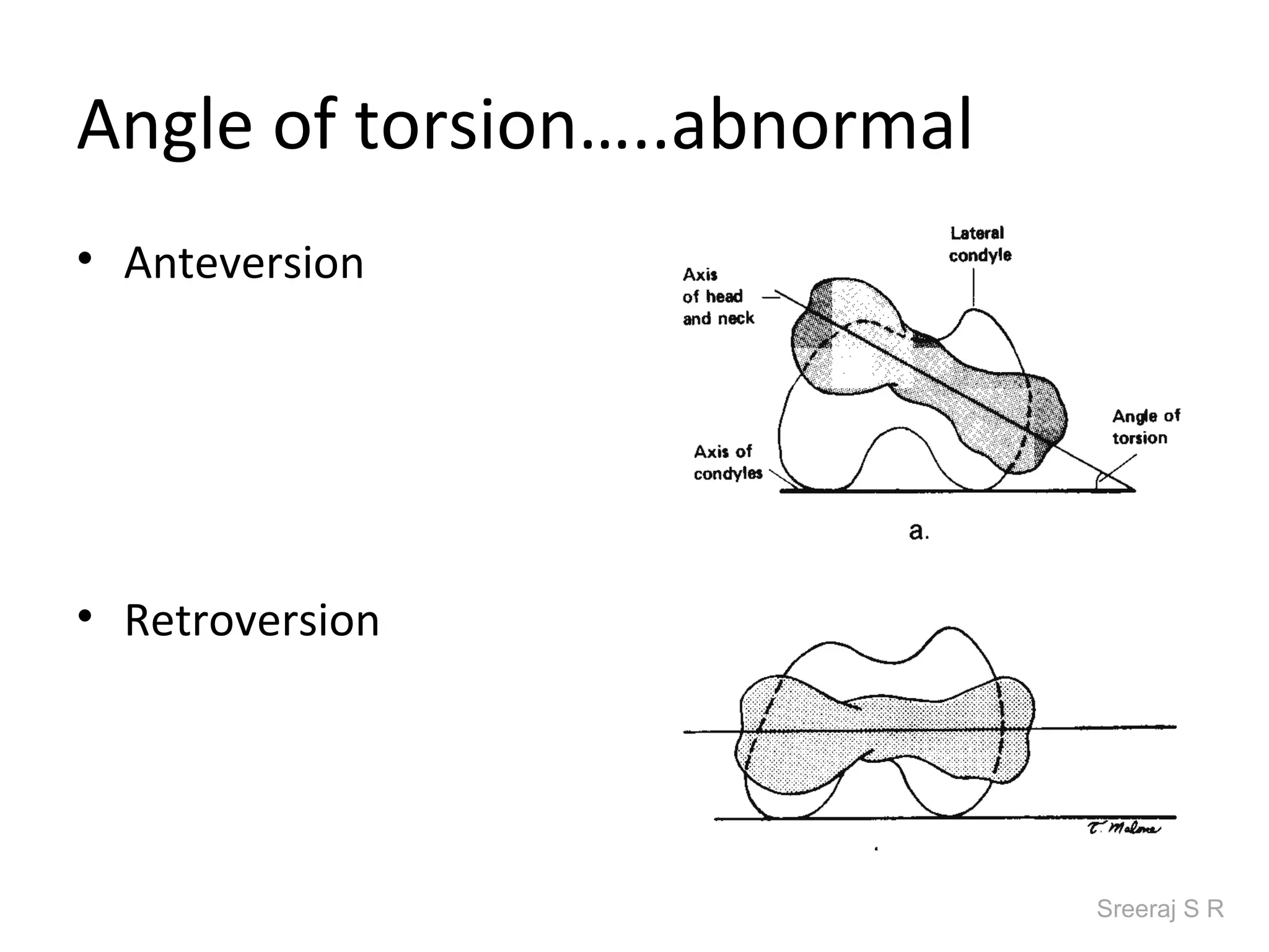 Angle of torsion…..abnormal
• Anteversion




• Retroversion




                              Sreeraj S R
 