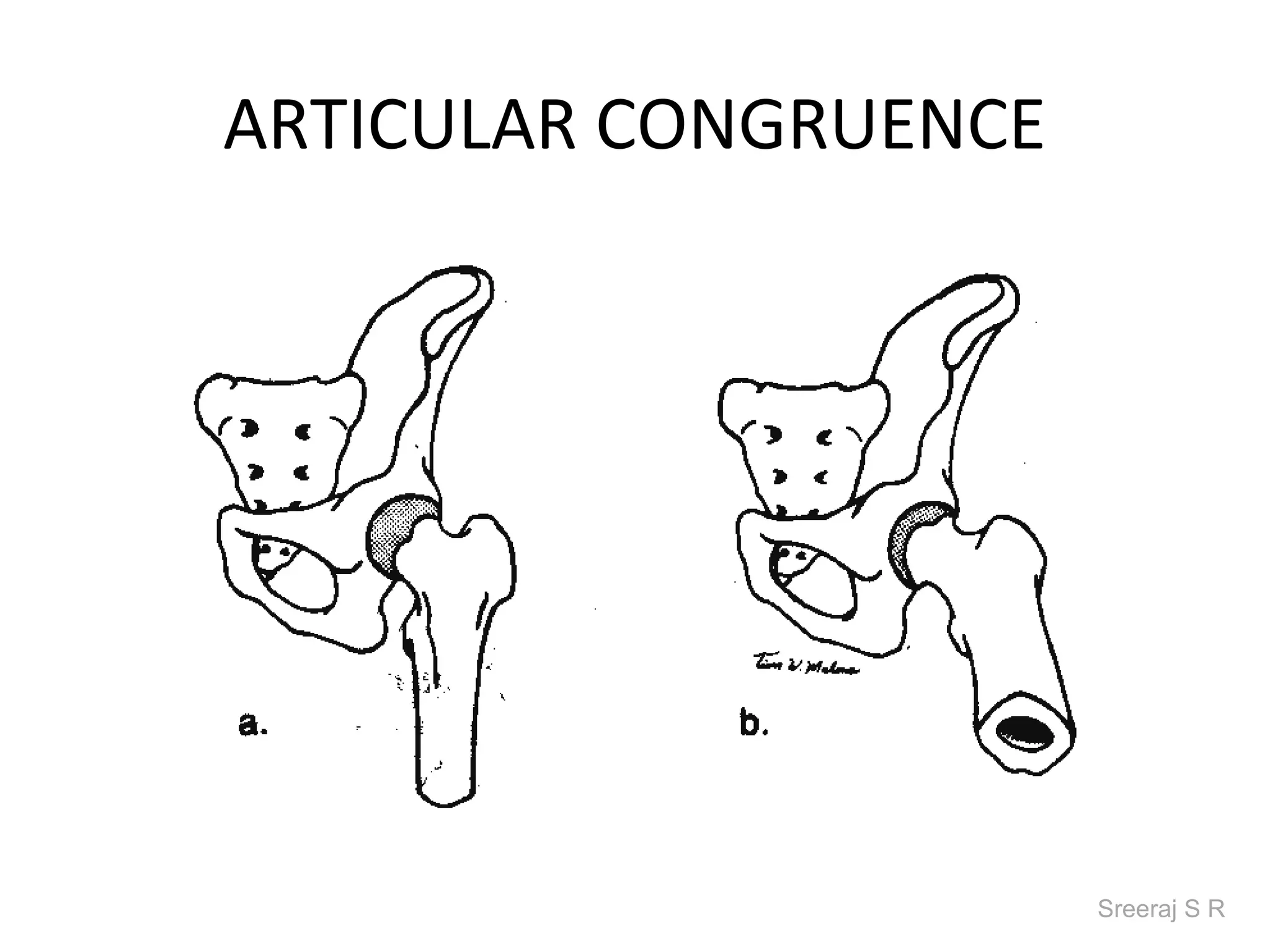 ARTICULAR CONGRUENCE




                       Sreeraj S R
 
