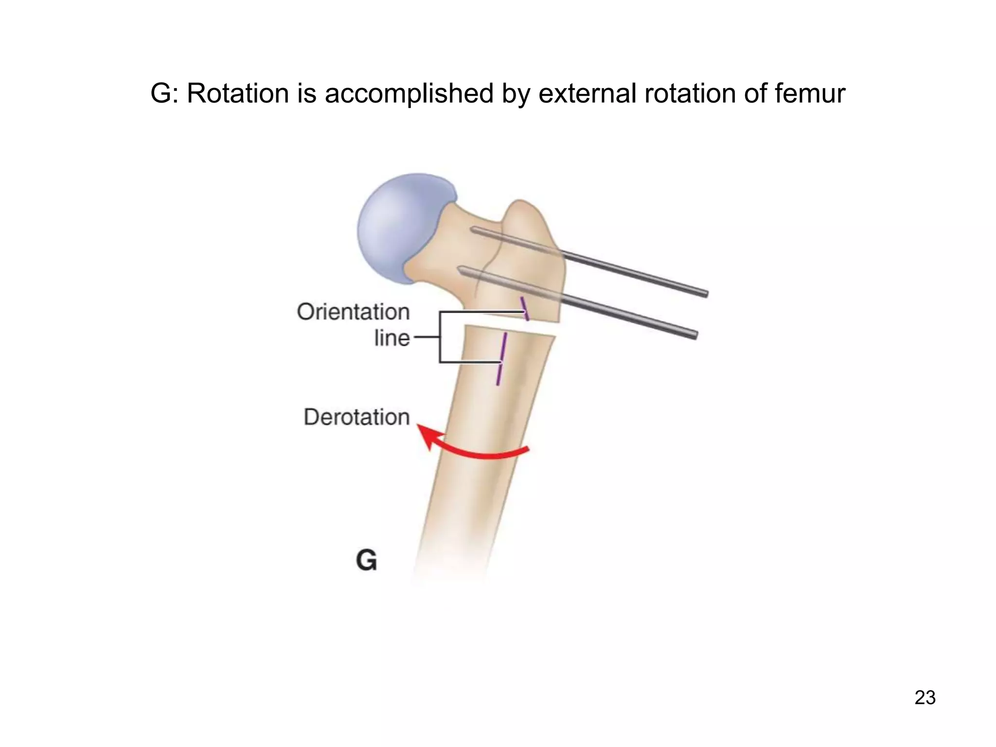 The hip in cerebral palsy part 2 of 2 | PDF
